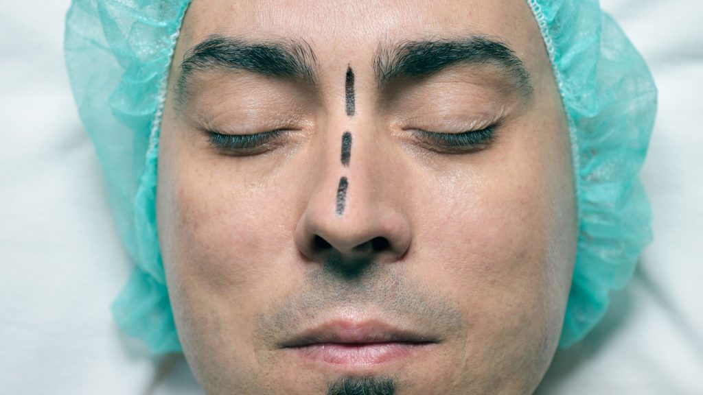 septoplastia em Perdizes